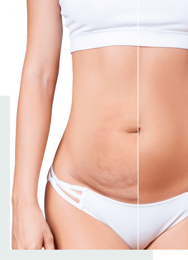 abdominoplastie-tunisie