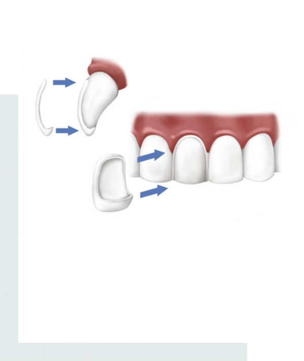 facette-veneers-prix-tunisie