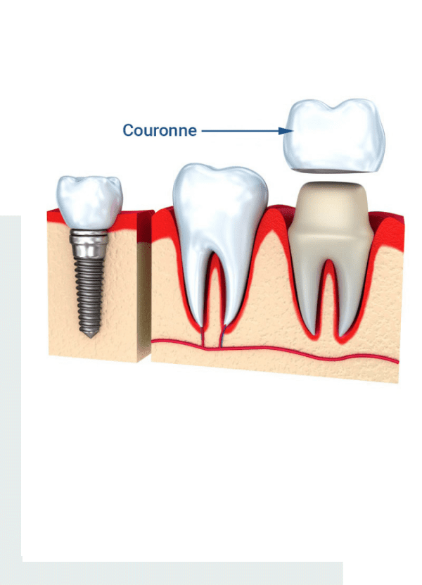 couronne-dentaire-tunisie