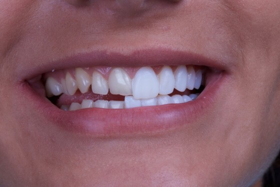 Quand doit-on se limer les dents ? - Pourquoi limer les dents ?