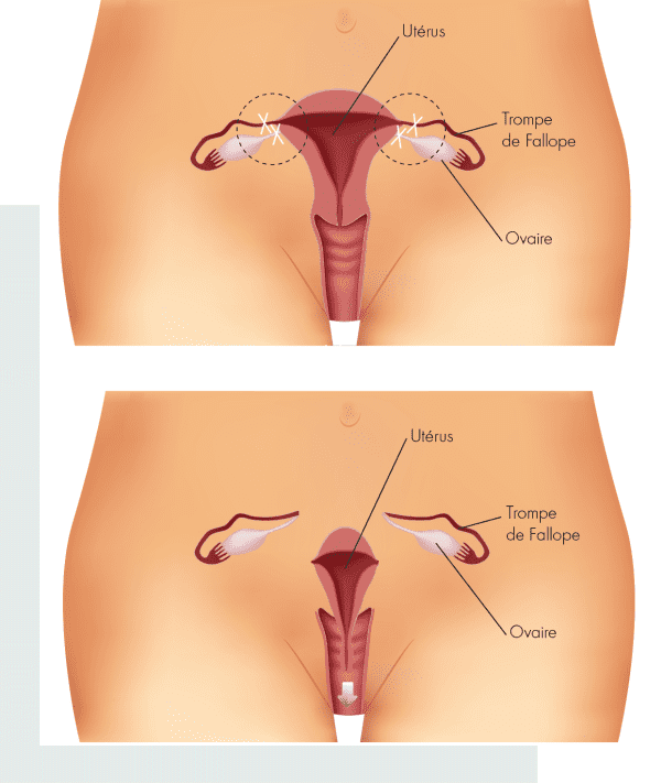 ablation-uterus-tunisie-prix