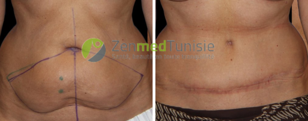 abdominoplastie-positionnement-nombril-avant-apres