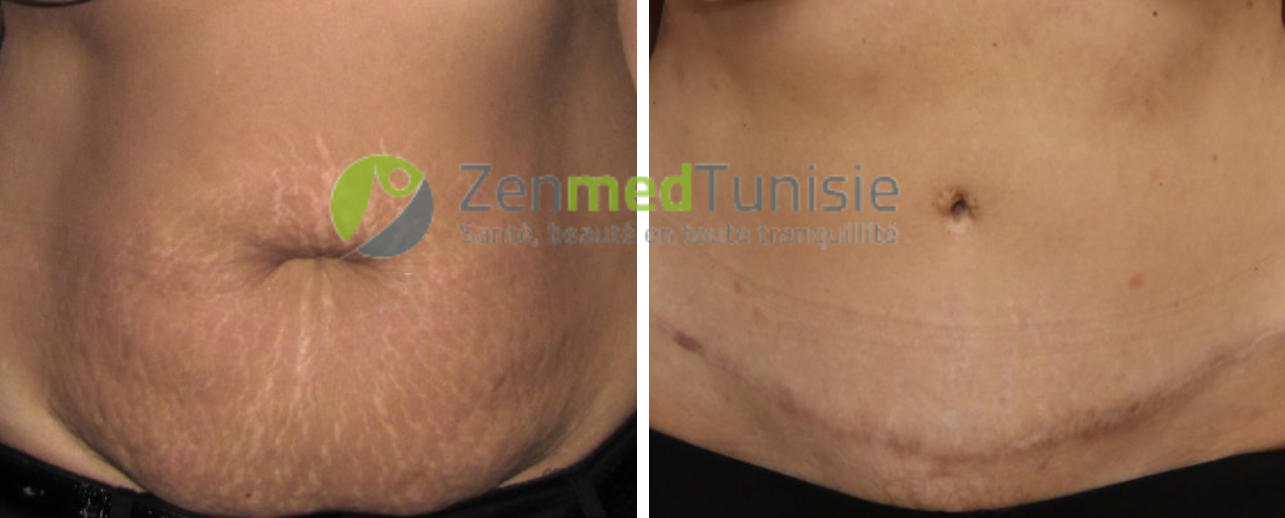 Lifting Du Ventre Abdominoplastie Photos Avantaprs — free download