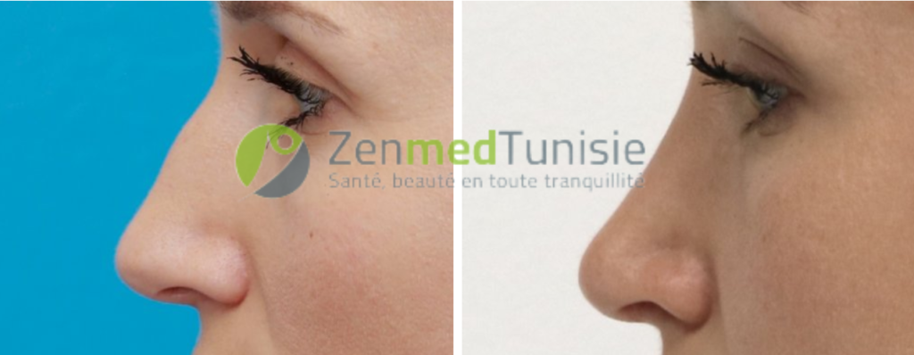 rhinoplastie-tunisie-avant-apres