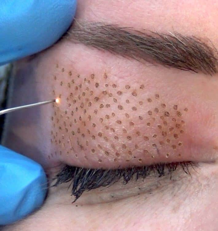 blepharoplastie-sans-chiurgie-plexr