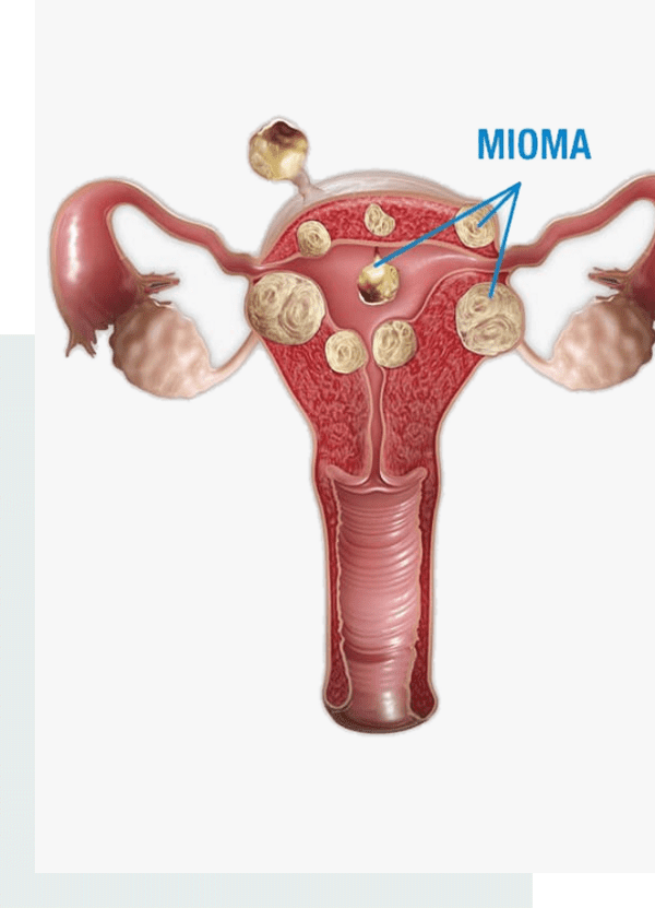 myomectomie-tunisie