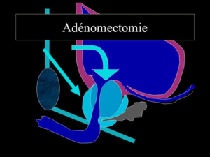 Adénomectomie