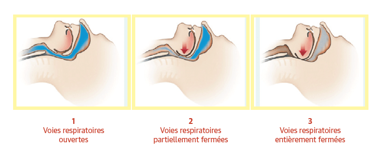 apnee-sommeil